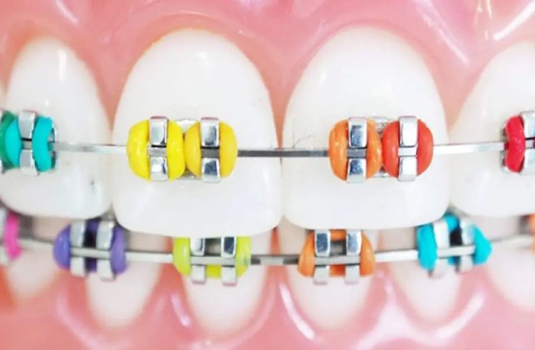 Порівняння різних типів брекет-систем
